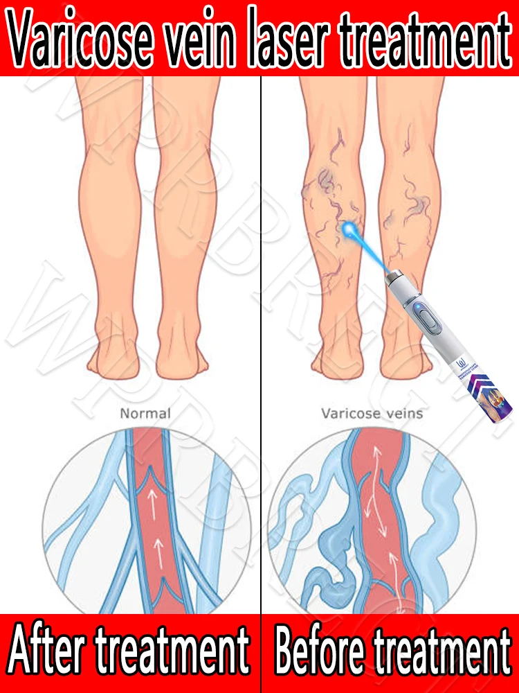 

Intravenous laser: Treating various venous problems