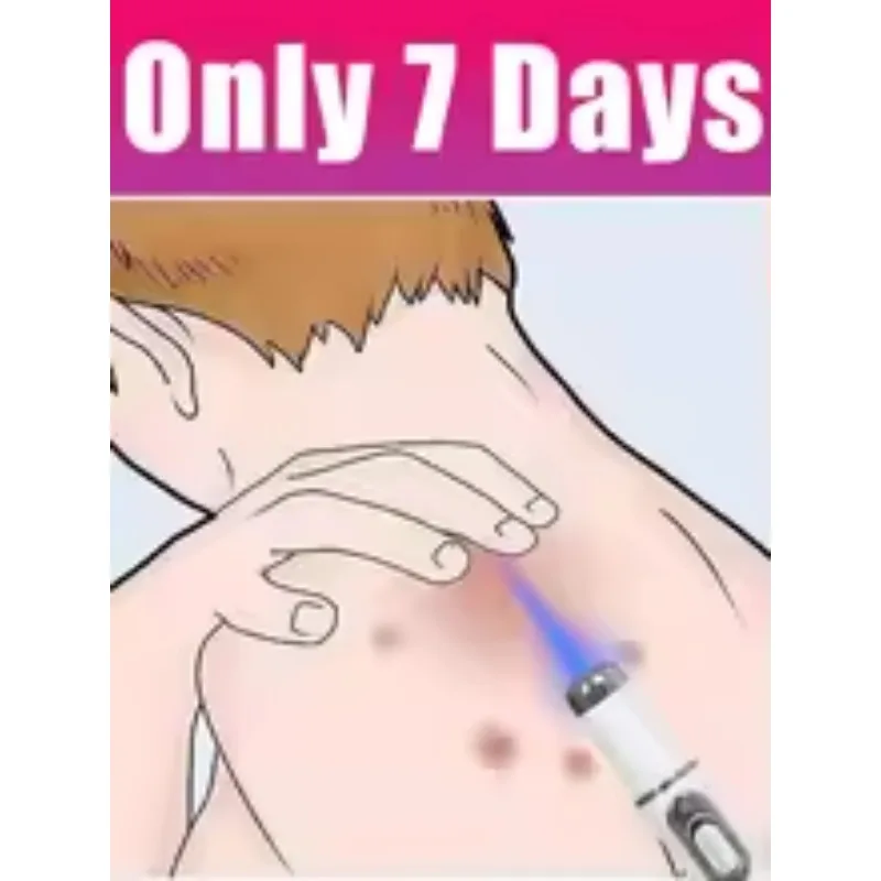 

Ручка с синим светом решает бородавки, горячие инструменты для ухода за бородавками