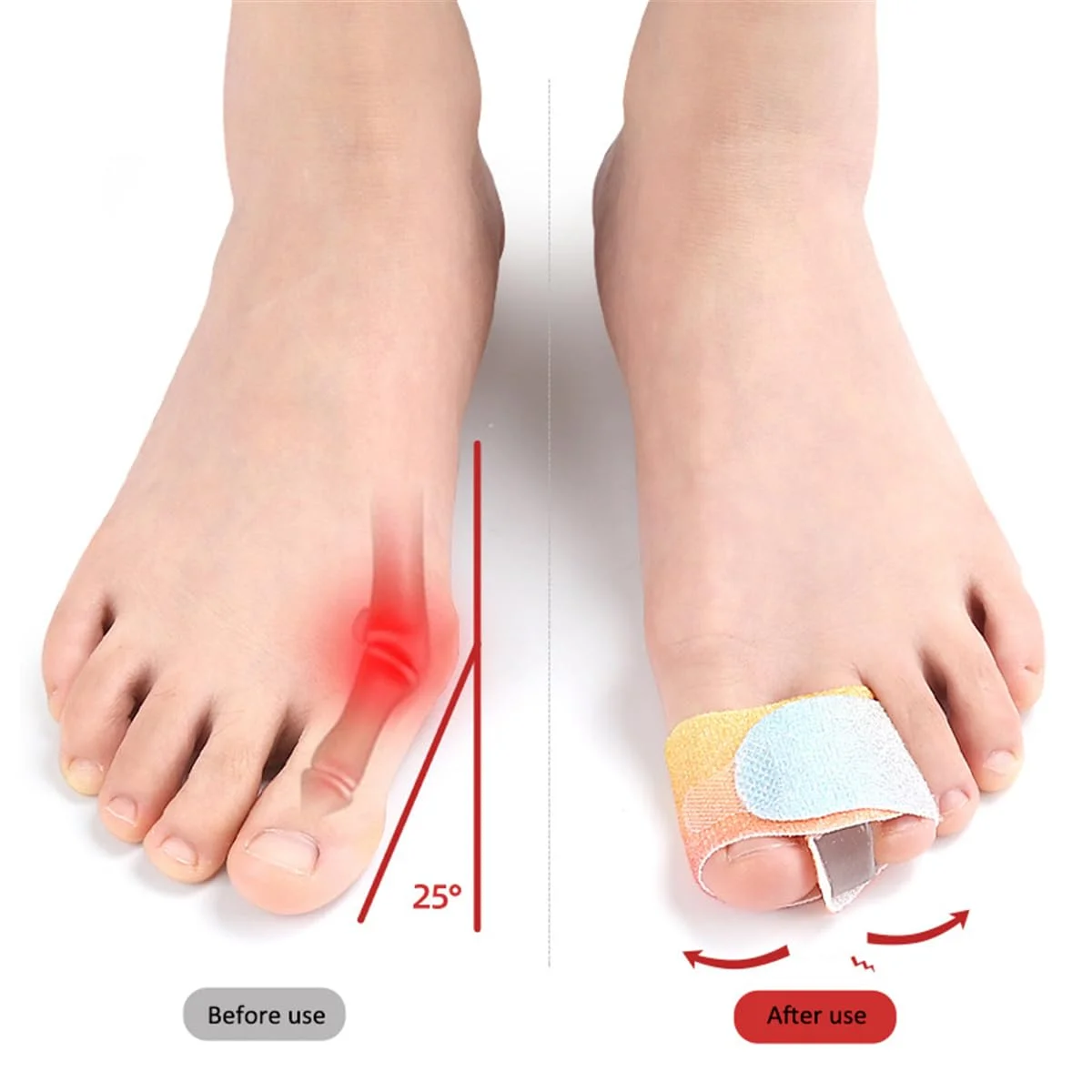 2PCS Colorful Gel Toe Separator – Suitable for Hallux Valgus, Overlapping Toes, and Big Toe Correction