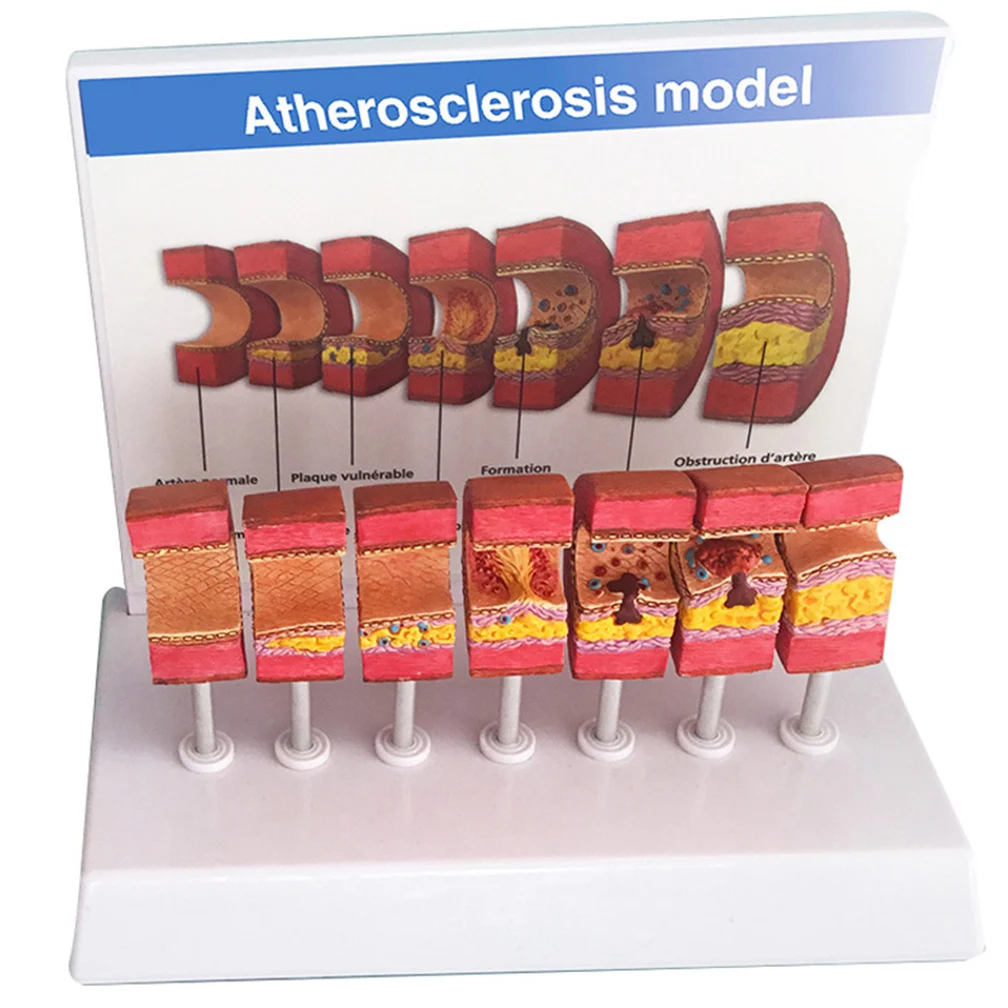 7 Stages In 1 Arterial Vessel Atherosclerosis Model Middle-Aged And Elderly Blood Vessel Structure Anatomia Models Medical Set