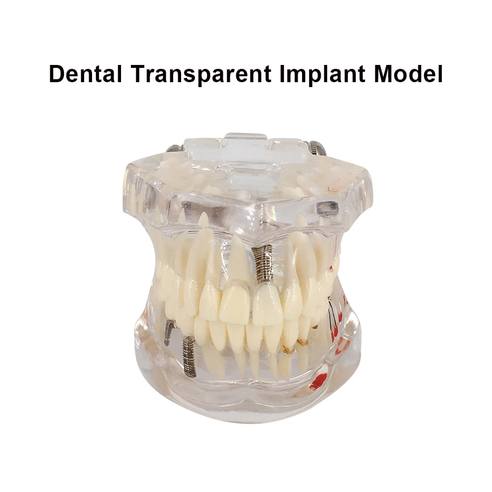 Dental Implant Model Transparent For Patient Education Communication Dentist Student Teaching Traning Dentistry Product Supplies