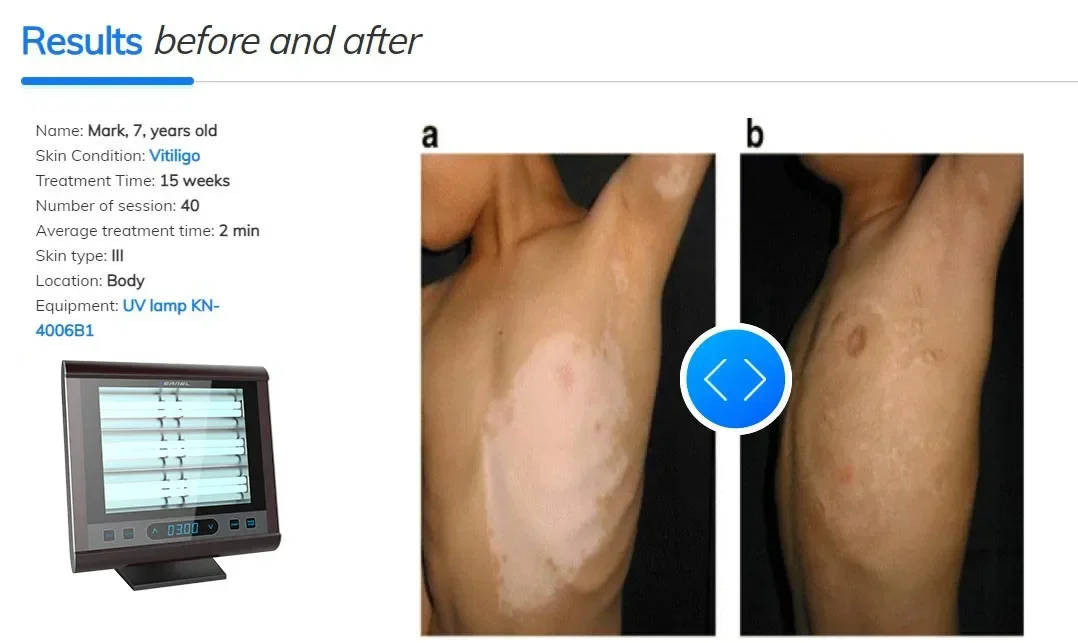 Kernel KN-4006B1 Table-top NB UVB lamp vitiligo  treatment machine 311 nm uvb phototherapy uvb psoriasis light therapy