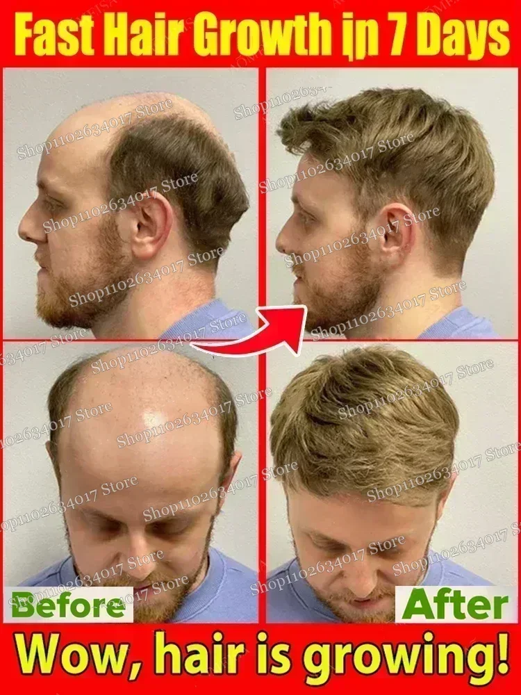 Nutre y cuidado del cabello masculino y femenino Tratamiento reparador con crecimiento del cabello Tratamiento de alopecia seborreica para adelgazar el cabello