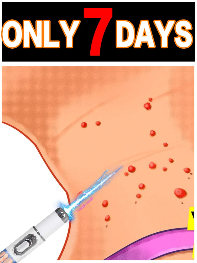 2nd generation upgraded wart , repair warts root , quickly