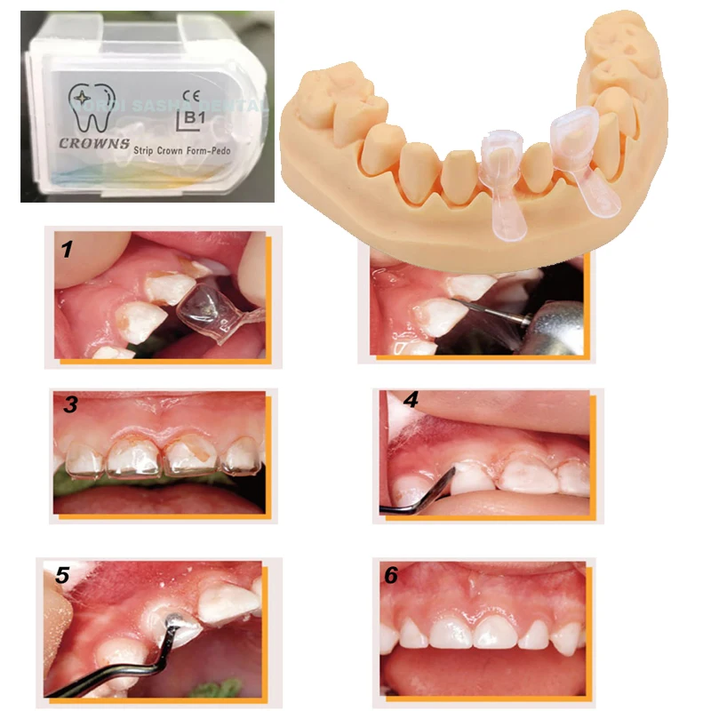 

5Pcs=1Box Transparent Dental Strip Crown Form-Pedo Kids Pediatric Deciduous Primary Anterior Molar Primary Crown