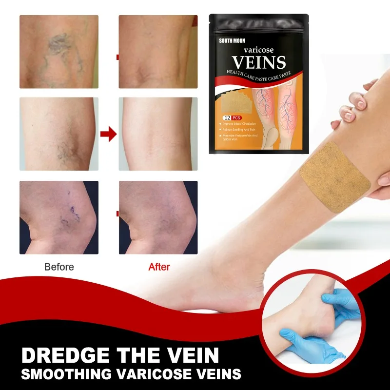 12pcs Vein Care Patch Multipurpose Relieve Foot Varicose Blood Vessel Blockage and Protrusion Cold Compress Vein Care Patch