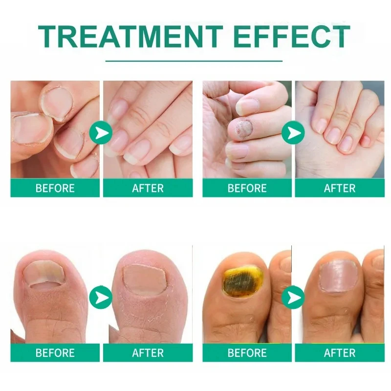 Nail Care Facial Essence Hand and Foot Care Toenail Thickening and Yellowing Care Essence Ingrown Nail Gray Nail Repair