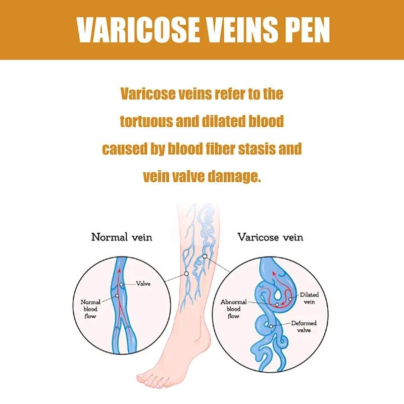 Terapia de abajur para varizes, alívio eficaz da vasculite dilatada nas pernas, flebite, melhor circulação sanguínea