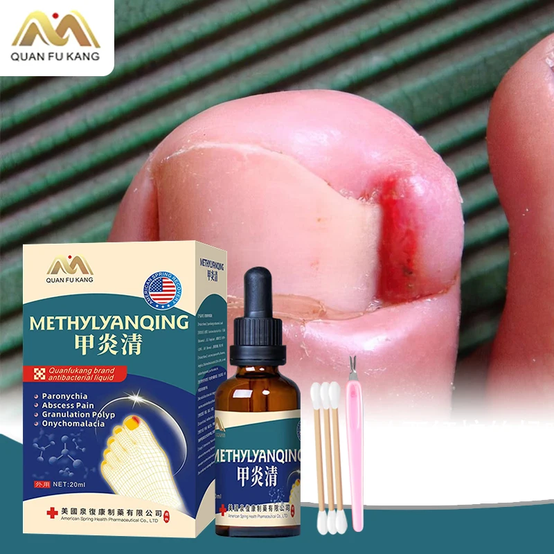 

Paronychia Treatment Liquid Nail Fungus Toenail Fungal Cleaner Nail Ingrown Correction Onychomycosis Care Tools American Formula