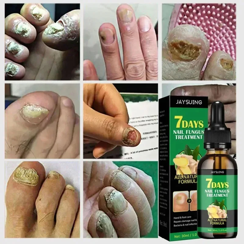 7 Day Nail Fungal Treatment Serum Foot Toe Nail Fungus Removal Essential Oil Anti Infection Onychomycosis Paronychia Repair Gel