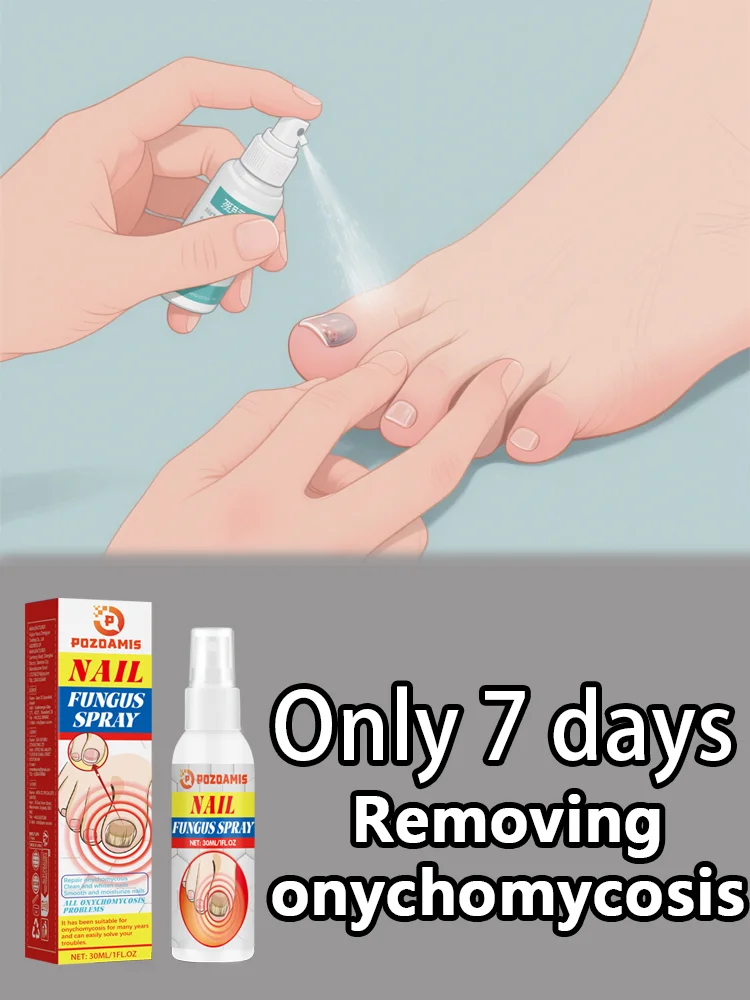 Spray antimicótico para uñas: limpia las uñas dañadas y descoloridas, fácil de usar.