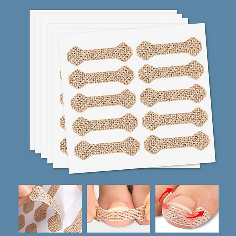 10pcs/Sheet Orthodontic Nail Patch Ingrown Armor Grow Into Flesh Toe Pad Manicure Patch Orthosis Skin Friendly Breathable