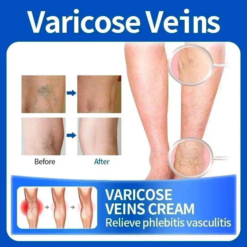 Pommade naturelle pour varices, crème de soin des pieds, support de vascularite, araignée américaine