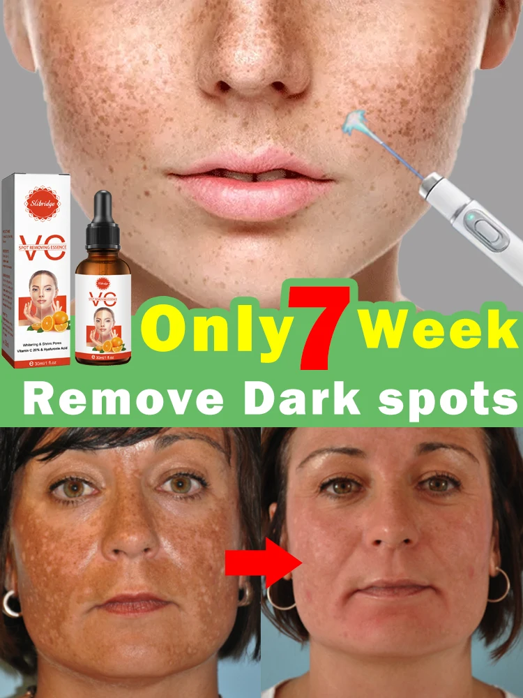 Dark Sun Age Spot Freckles Clear