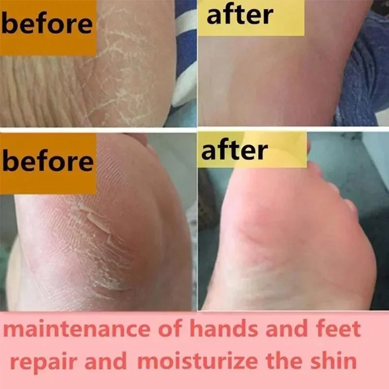 Herbal Anti Crack Foot Cream Heel Cracking Repair Products Exfoliation Dead Skin Removal Softening Moisturize Smooth Skin Care