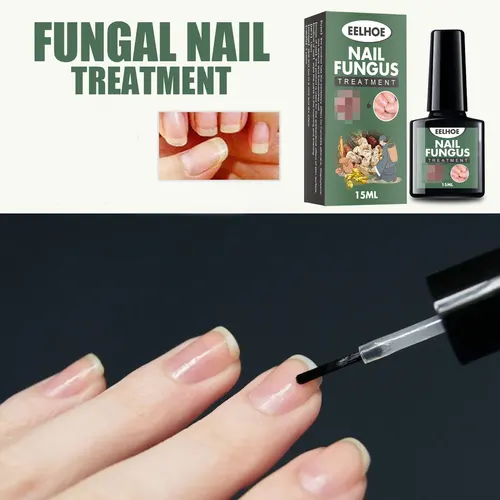 Imagen 2 del producto Tratamiento de hongos en las uñas, aceite esencial para eliminación de hongos en las uñas de los pies, reparación de suero, productos de cuidado de Gel antiinfección onicomicosis