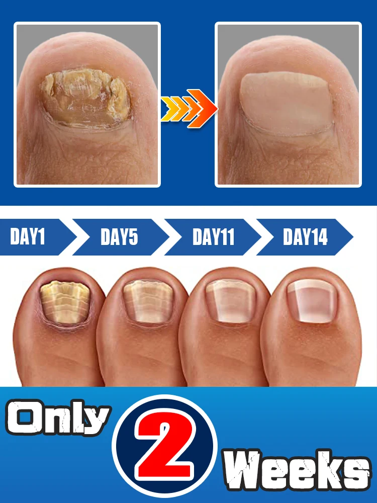 

Are you still worried about your nail health