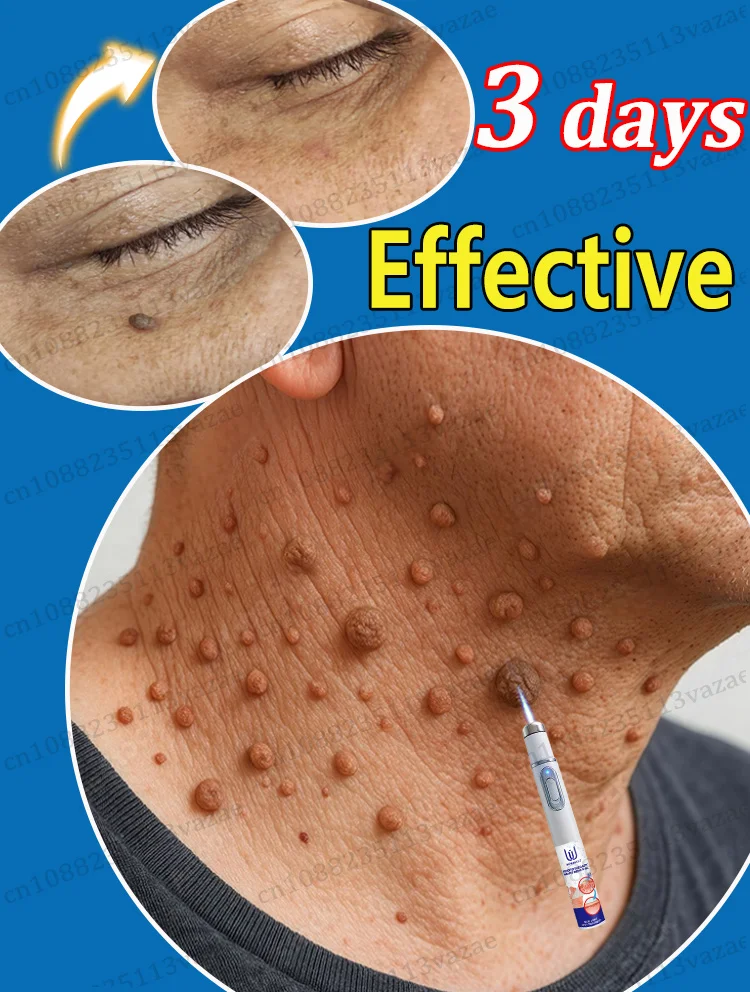 

Verwijder alle soorten wratten en maak uw huid glad