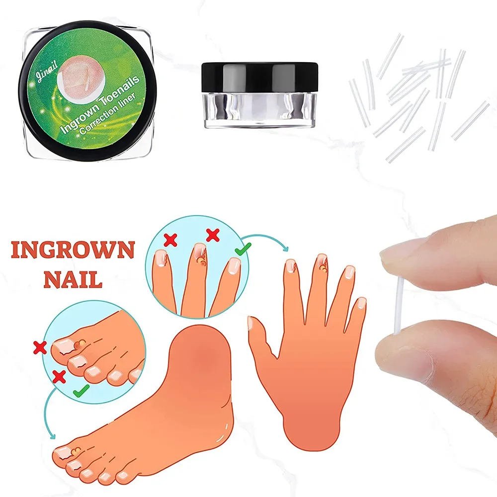 Teennagel Rechttrekken Clip Ingegroeide Teennagel Correctie Tool Set Nagel Behandeling Elastische C-Vormige Patches Pedicure Voetverzorging Tools