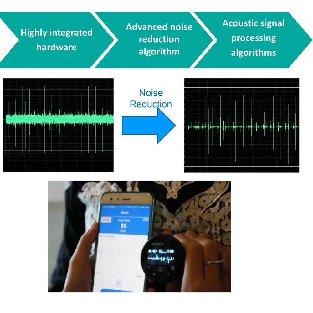 Bluetooth Electronic Stethoscope Rechargeable Digital Stethoscope 100x Audio Amplification OLED Display Respiratory Diseases