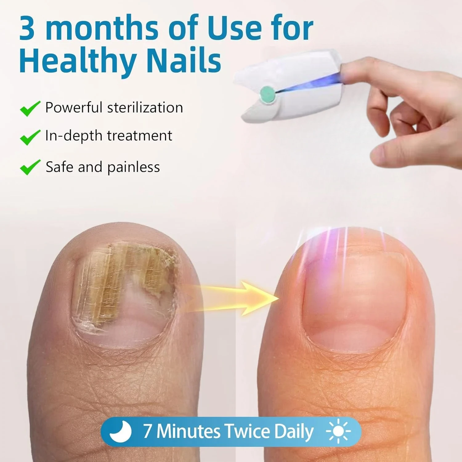 

Nail Fungus Remover Laser Device,Painless Therapy Treatment For Toes And Fingernails, Portable, Treats Nail Discoloration