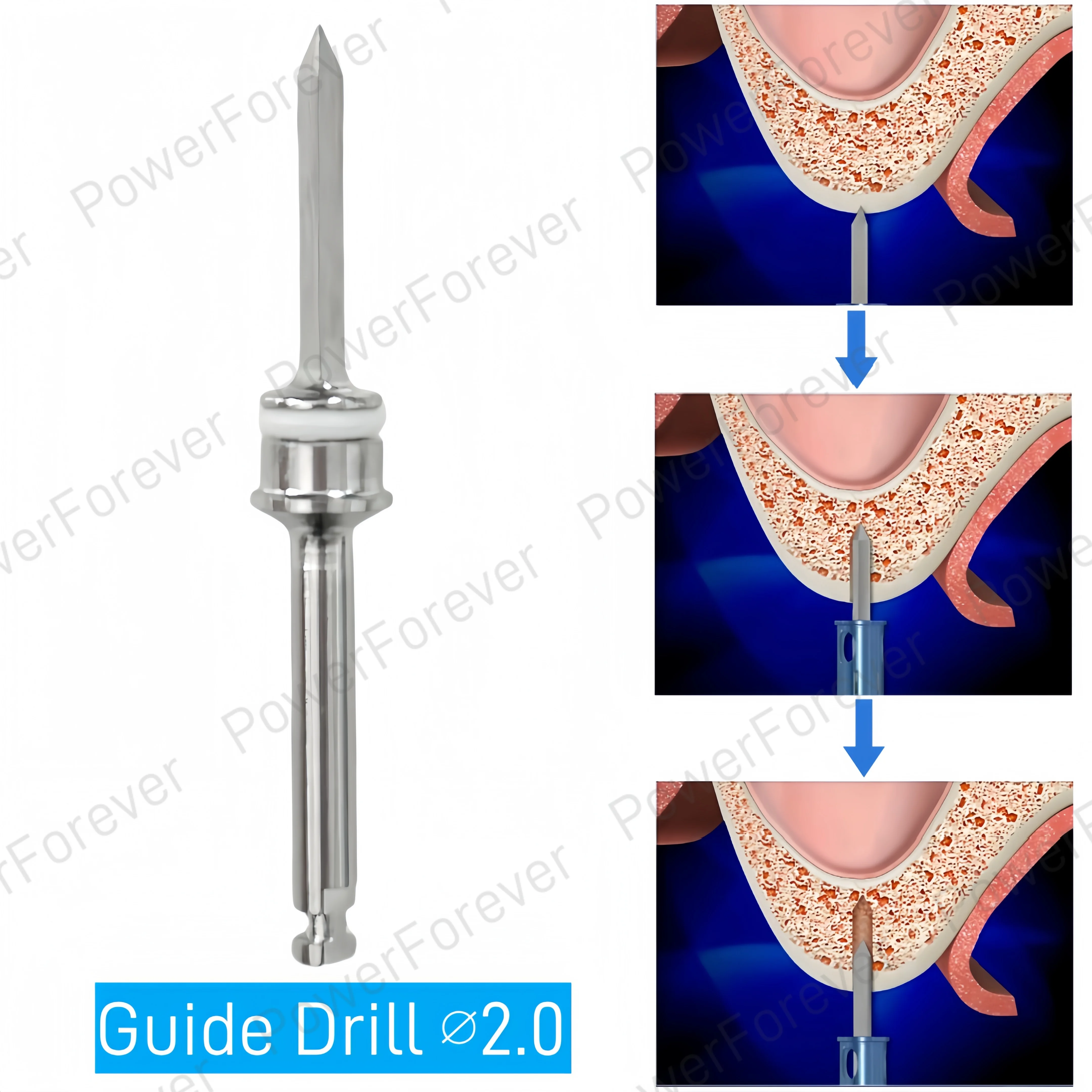 Dental Maxillary Sinus Lift Membrane Water Rising Hydraulic Lifter Aqua Tip Water Pipe CAS Crestal Guide Drill Implant Surgical