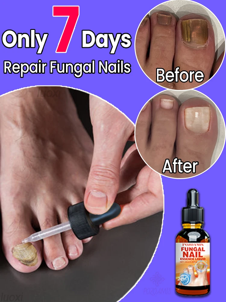 

ᶜᵘʳᵉ ᵒⁿʸᶜʰᵒᵐʸᶜᵒˢⁱˢ⸴ ʳᵉᵍᵃⁱⁿ ʰᵉᵃˡᵗʰʸ ⁿᵃⁱˡˢ⸴ ᵃⁿᵈ ˢᵃʸ ᵍᵒᵒᵈᵇʸᵉ ᵗᵒ ᵗʰᵉ ᵗʳᵒᵘᵇˡᵉˢ ᵒᶠ ᵗʰⁱᶜᵏ⸴ ʸᵉˡˡᵒʷ⸴ ᵃⁿᵈ ᵇʳⁱᵗᵗˡᵉ ⁿᵃⁱˡˢ