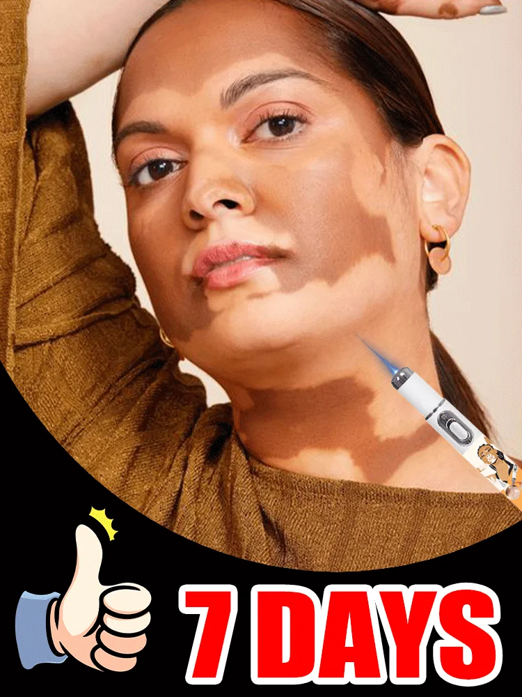 

Vitiligo Treatment Device 2nd Upgraded Version⸴Vitiligo Treatment⸴Fast