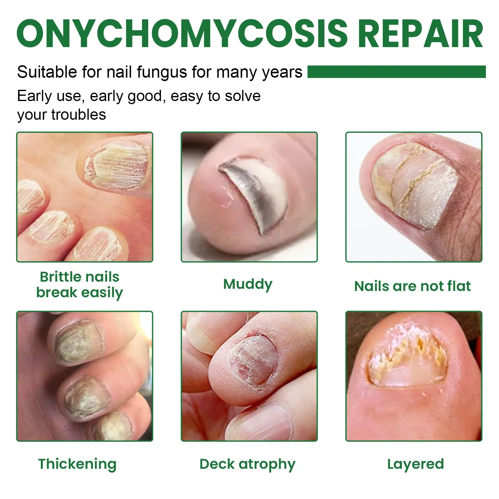 Gray Nail Repair Solution Onychomycosis Treatment Toenail Fungus Nail Removal Paronychia Anti Infection Care Essence Liquid 20ml