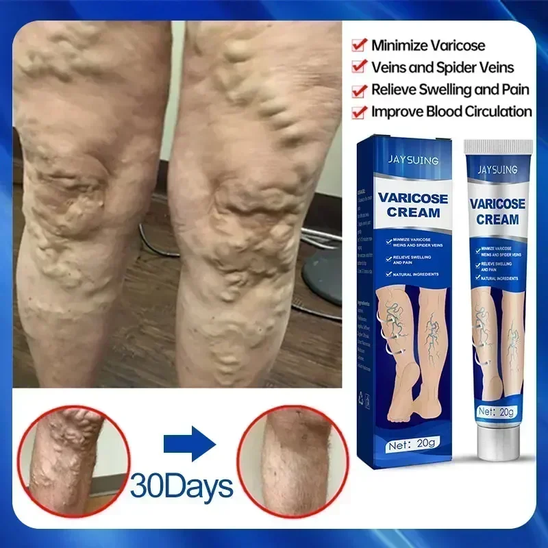 Varicose vein ointment, leg vasculitis, hot veins, body cream, and varicose veins cream