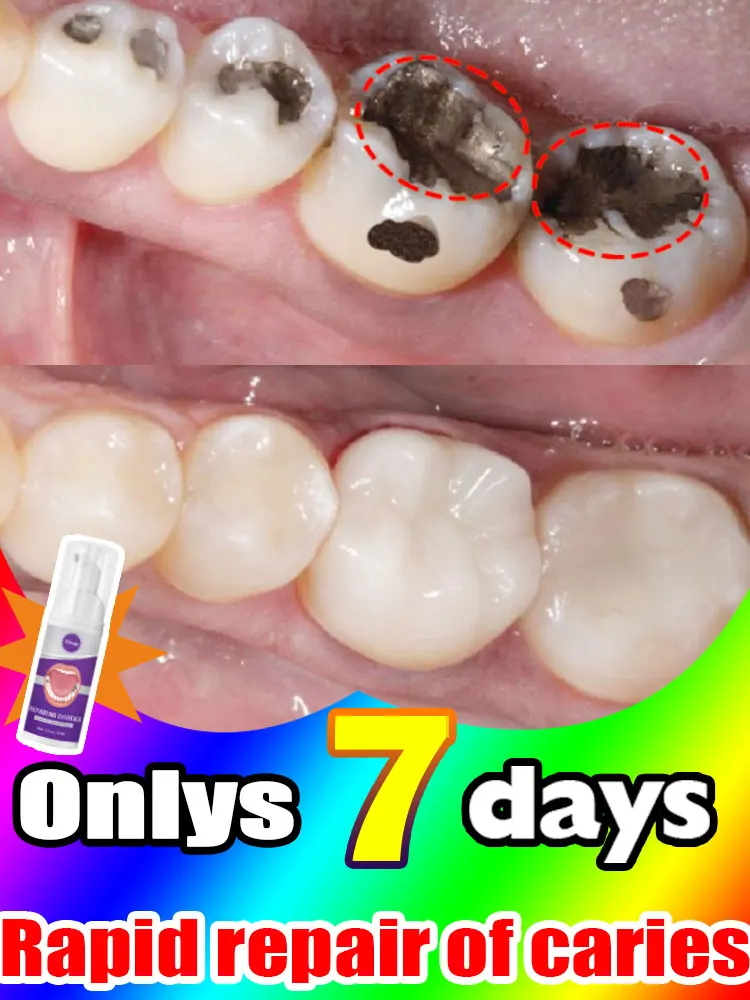 

Solves caries and teeth decay problem