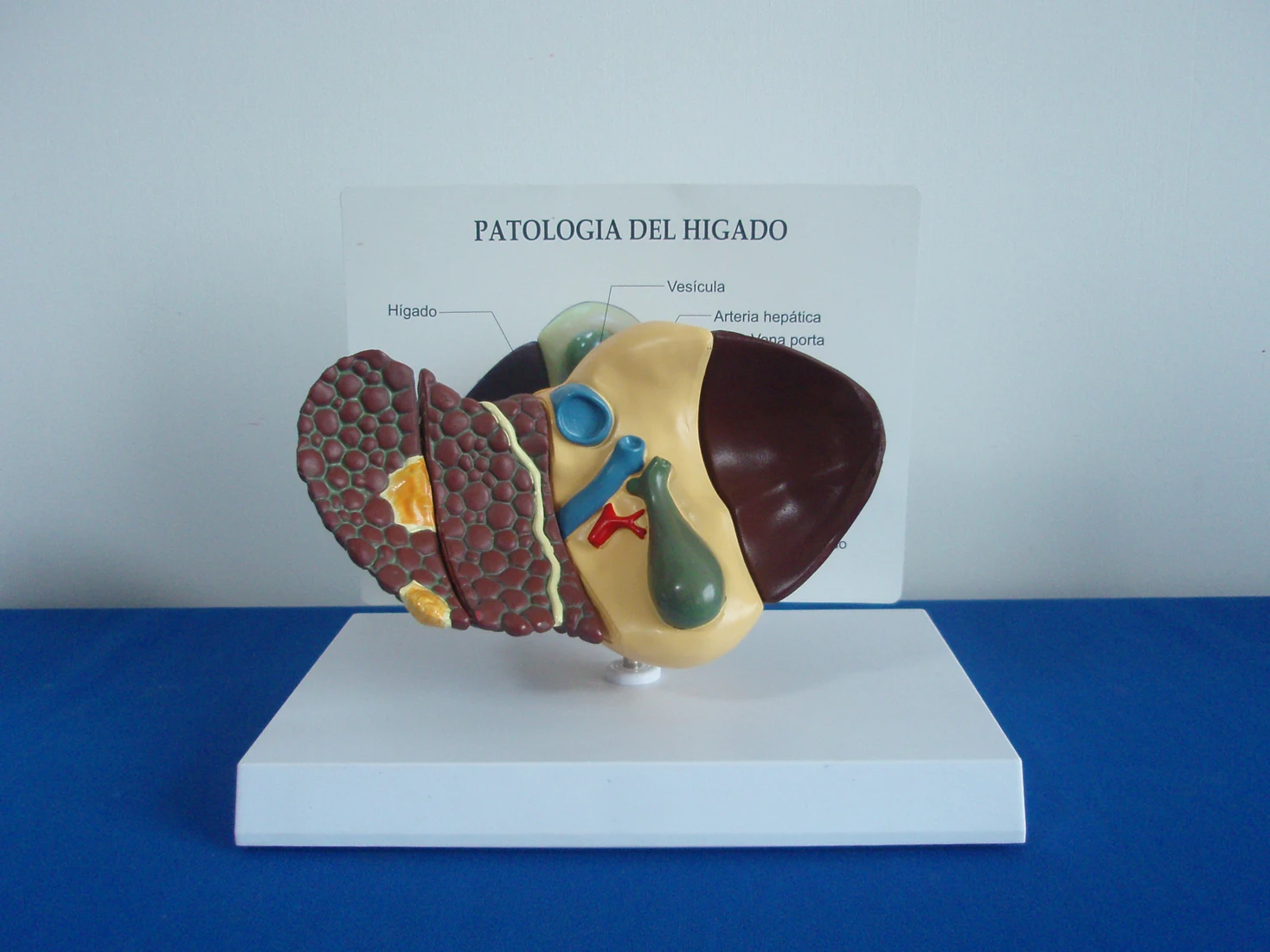 An anatomical model of chronic hepatitis for medical students with liver disease