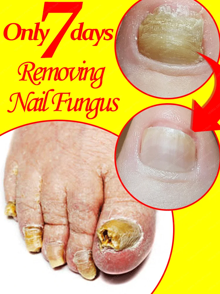 Sérum de traitement fongique des ongles, élimination des champignons des pieds, Gel de réparation, Anti-Infection, Paronychia, onychomycose, Essence de soin des ongles