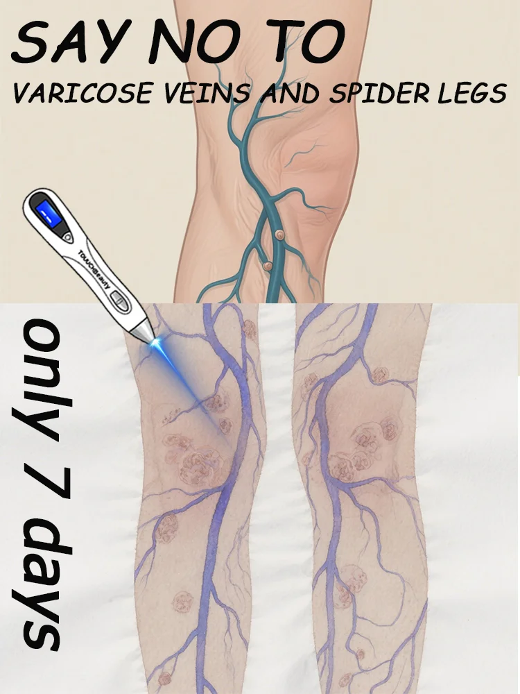

Средства по уходу для снижения дискомфорта ног, улучшения кровообращения, ручки для варикозного расширения вен, средства по уходу за кожей.