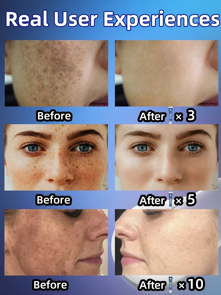 Freckle Whitening Cream Melasma Removal Dark Spots Fade Brighten