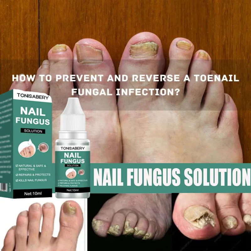 

Nail Fungus Treatment Serum Foot Repair Liquid Toe Nails Fungal Removal Gel Anti Infection Paronychia Onychomycosis Cream 10ml