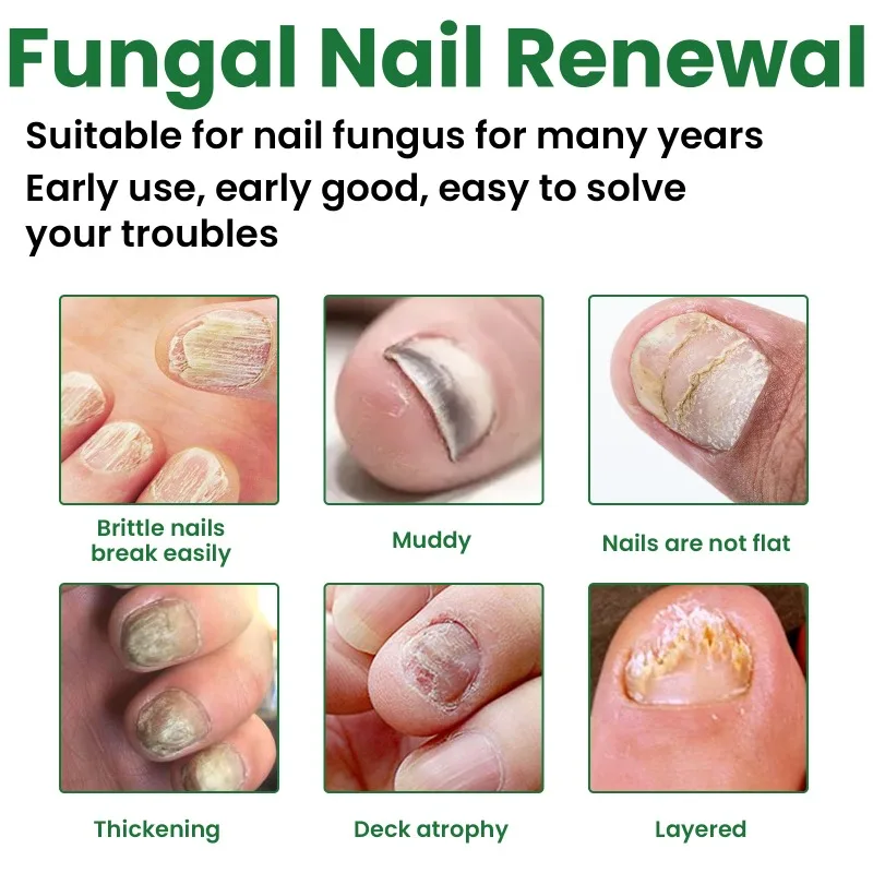 30ml Fungal Nail Renewal Deep Bacteriostatic Nourishing Brightening Nail Remove Bad Nails Daily Care Herbal Exfoliation Solution