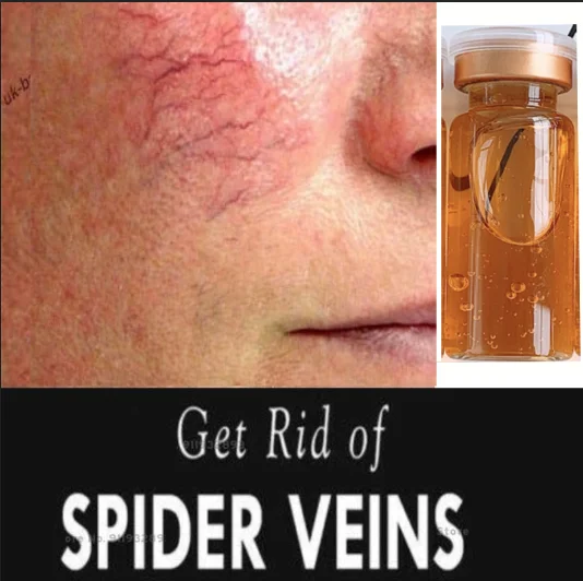 

FAST Anti Redness & Spider Vein Removal Advanced Treatment Clearer Skin Veins on Face Redness Removal Serum