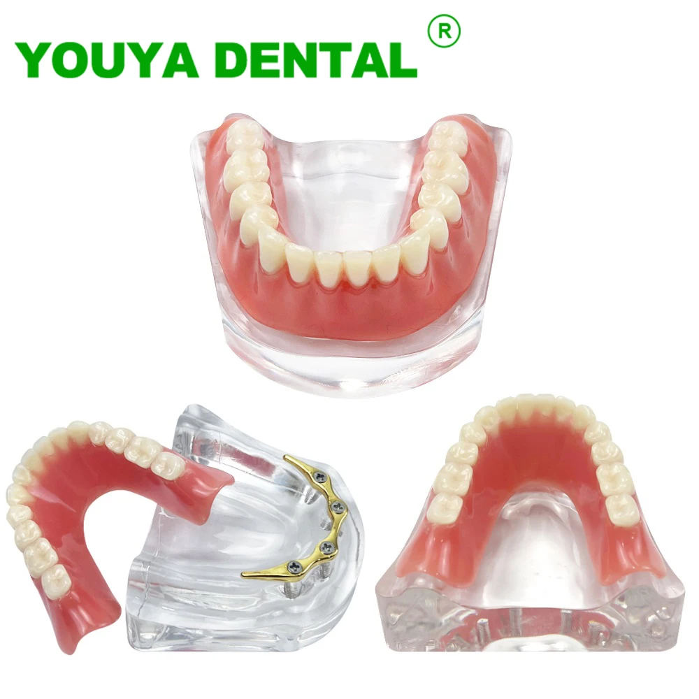 Dental Implant Overdenture Teeth Model 4 implants M6009 Typodont With Golden Bar Lower Restoration Demo Model Dental Products