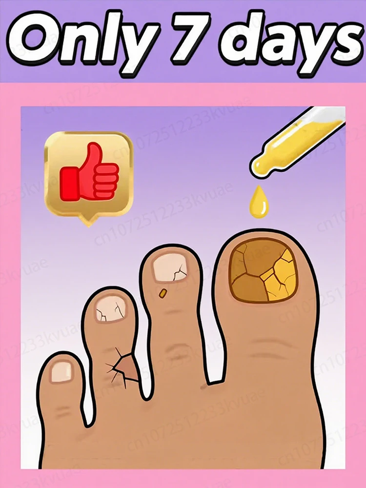 

Sᴇᴄᴏɴᴅ ɢᴇɴᴇʀᴀᴛɪᴏɴ ᴇssᴇɴᴛɪᴀʟ ᴏɪʟ, 7 ᴅᴀʏs TO ʀᴇᴍᴏᴠᴇ ɴᴀɪʟ ғᴜɴɢᴜs