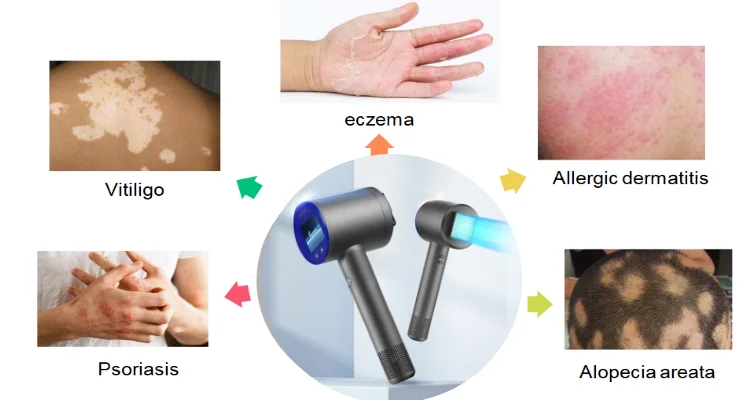 Peninsula phottherpy LED 311nm  Healthcare Pototherapy  Vitiligo UVB Lamp Vitiligo Psoriasis