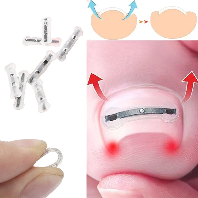 내성발톱 교정 도구 내성발톱 치료 탄력 패치 스티커 교정 클립 브레이스 페디큐어 도구