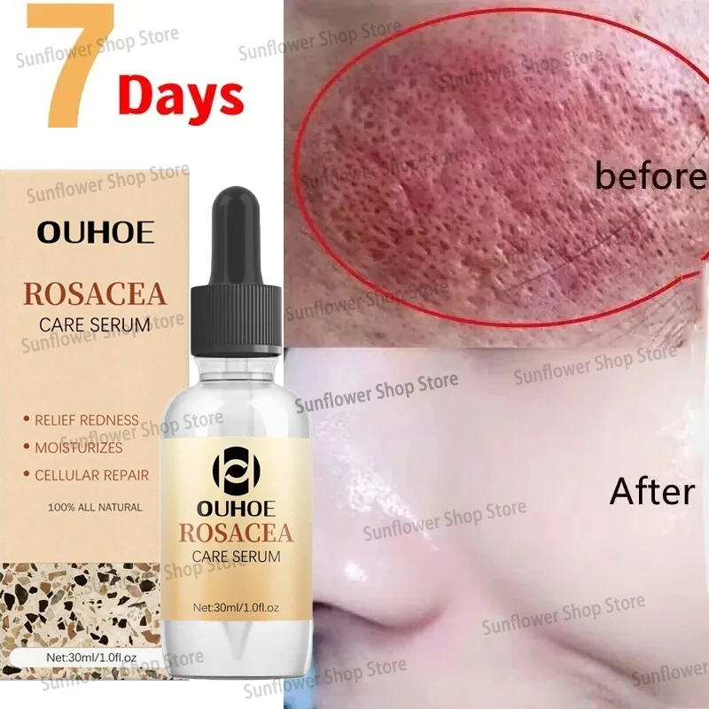 Facial Redness Repair Cream Rosacea Red Blood Acne Treatment Anti Aging Improve Sensitive Skin Moisturize Brighten Korean Care