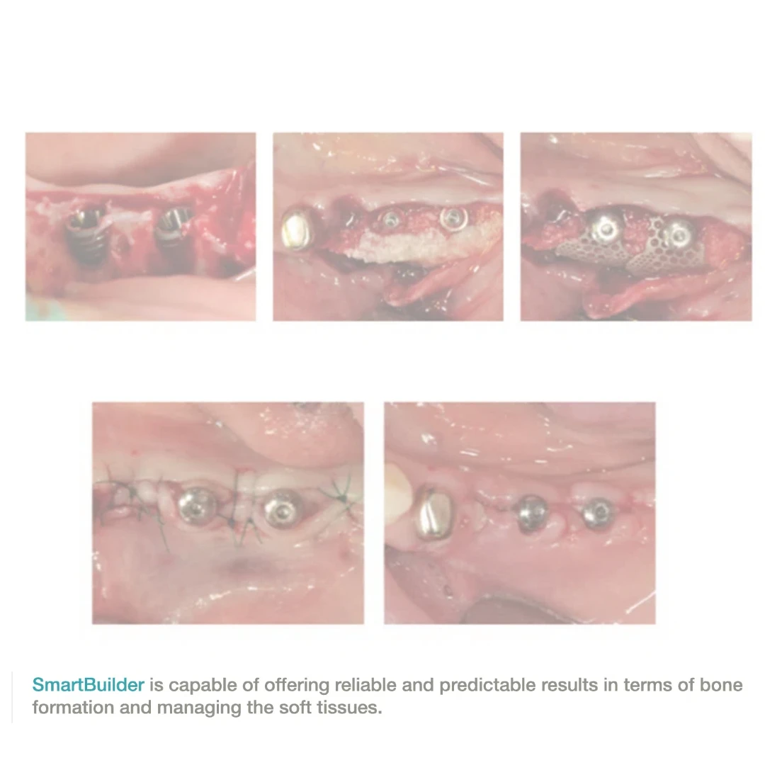 10Pcs Dental Smartbuilder Cover Cap Φ4.8 Multi Unit Protective Caps 1-Stage Compatible with OssBuilder