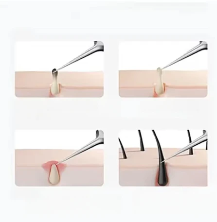 Stainless Steel Ingrown Hair Tweezers Acne Blackhead Removal Needles Black Dots Cleaner Pore Deep Cleansing Face Skin Care Tools