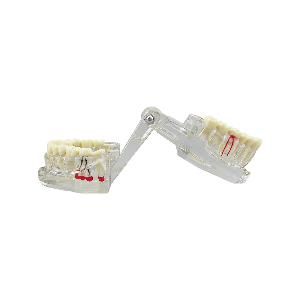 Removable Transparent Disease Teeth Model Teeth Restoration Model for Dentist Student Practice Training Oral Medical Models