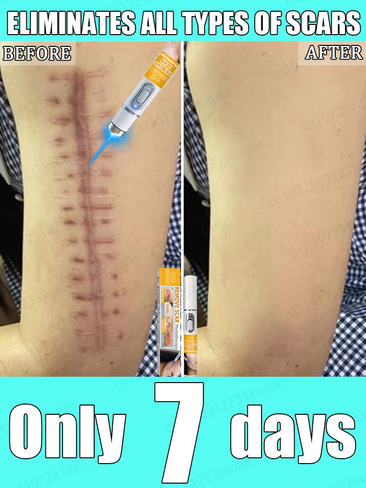 

Lᴀsᴇʀ sᴄᴀʀ ʀᴇᴍᴏᴠᴀʟ sᴜɪᴛᴀʙʟᴇ ғᴏʀ ᴀʟʟ sᴄᴀʀ ᴛʏᴘᴇs, sᴀғᴇ ᴀɴᴅ ʜᴇᴀʟᴛʜʏ sᴄᴀʀ ʀᴇᴍᴏ