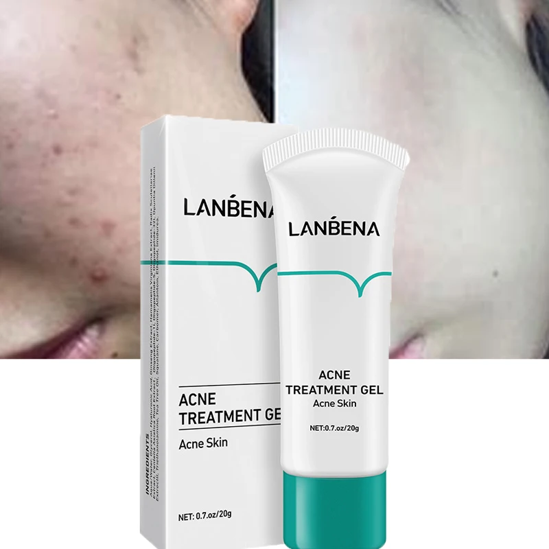 LANBENA Acne Treatment Face Cream Anti-acne Shrink Pores Oil Control Repair Skin Remove Pimple Whitening Moisturizing Skin Care