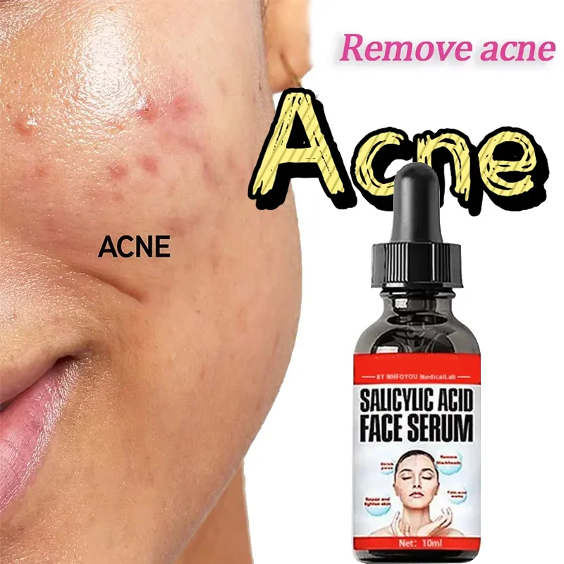 

Herbal Acne Removal Cream Whitening Moisturizing Shrink Pores Acne Treatment Gel Oil Control Pimples Scar Skin Care Face Cream