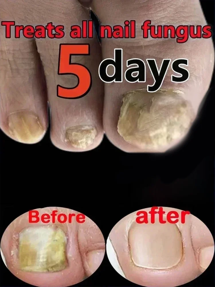 

3ND инструменты для чистки ногтей, лазерные инструменты с синим светом, ремонт корней, модернизированные второго поколения Y26